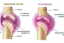 Остеоартроз суставов лечение симптомы степени
