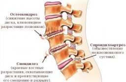 Различные виды остеохондроза