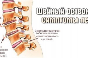 Шейный остеохондроз: симптомы и лечение