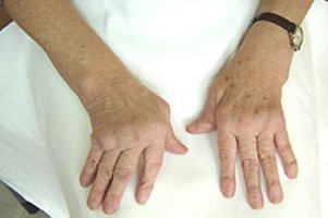 Способы лечения остеоартроза кистей рук
