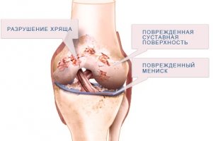 Симптомы и лечение остеоартроза коленного сустава