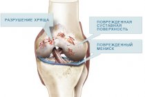 Лечебная йога при остеоартрозе