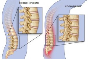 Анкилозирующий спондилит лечение симптомы причины