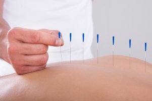 Преимущества иглоукалывания при остеохондрозе