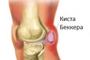 Киста Беккера под коленом – как лечить в домашних условиях