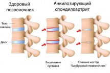 Асептический и другие виды спондилита