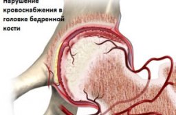 Лечение деформирующего коксартроза тазобедренного сустава
