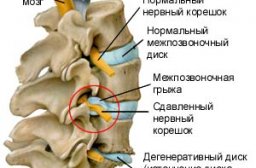Боли при шейном остеохондрозе: причины и лечение