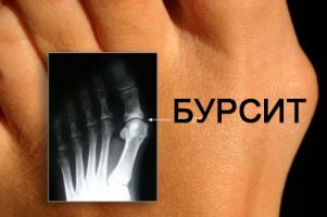 Что представляет собой бурсит и почему он возникает?