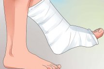 Перелом ноги: симптомы травмы и лечение