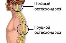 Остеохондроз лечение симптомы виды профилактические мероприятия