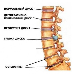 остеофиты