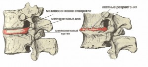 остеохондроз поясничного отдела