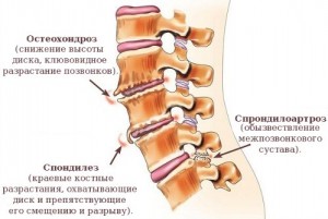 признаки спондилоартроза