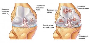 артроз сустава