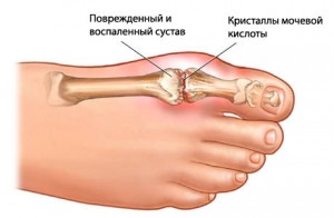 Причины развития подагры у мужчин
