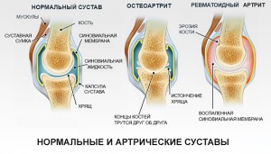 Виды артритов