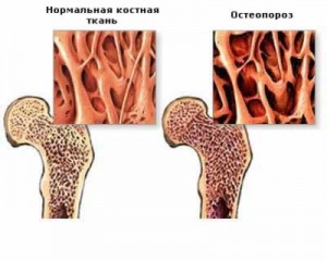 Что такое остеопороз